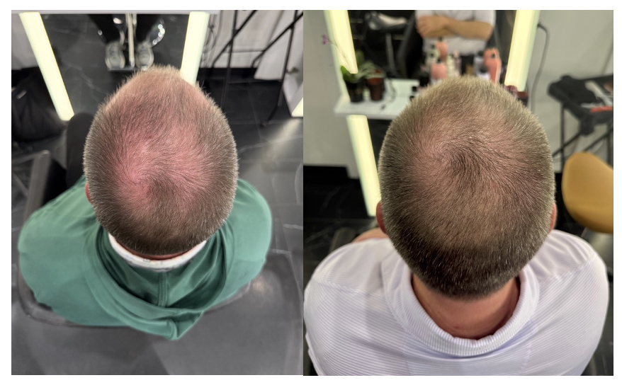Before and after of mens hair loss with treatment