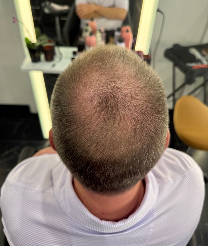 After photo of men's hair thinning
