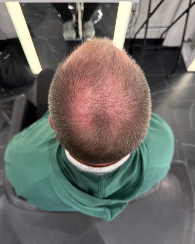 Before photo of men's hair thinning
